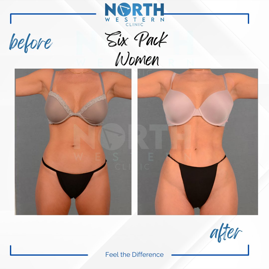 NorthWesternTR's tweet photo. Unleash your abs with abdominal etching! The latest technique to achieve a defined six-pack. Get ready to show off your hard work 💪 #AbsEtching #WomenWhoLift #SixPackGoals 📸 https://t.co/qEZEfxRxrE