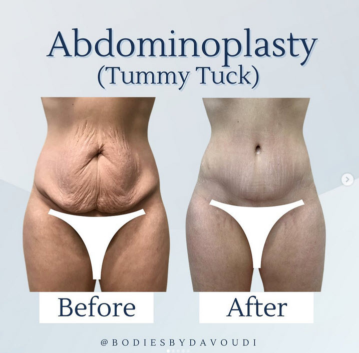 Tummy Tuck Duluth Georgia – Abdominoplasty Buckhead GA #tummytuck #abdominoplasty myatlantaplasticsurgeon.com/html/tummytuck…