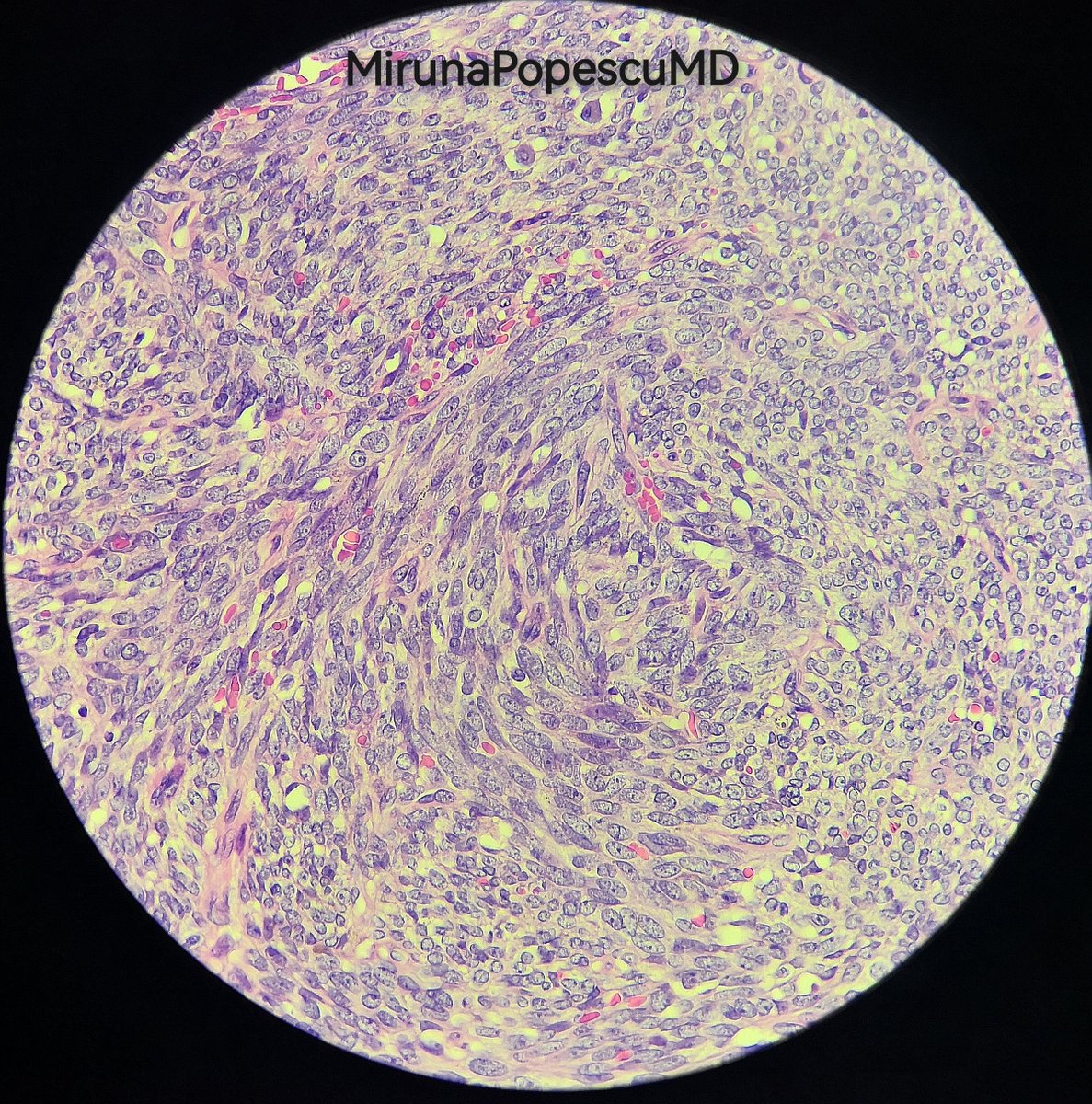 MirunaPopescu13's tweet photo. MPNST:
➡️ Sporadic, in NF1, or after RxT
➡️Hyper- &amp; hypocellular areas
➡️Perivascular accentuation
➡️Uniform spindle cells
➡️Sometimes fibrosarcoma-like fascicular (🐟bone) growth
➡️+/- hyalinized, myxoid stroma
➡️S100, SOX10 focal, patchy or -ve
➡️Loss of nc H3K27me3

#BSTPath https://t.co/C5QM5KAScv