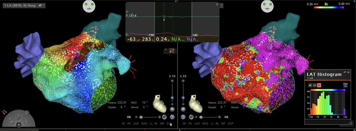 Dr Husain Shabeeh (@drhusainshabeeh) on Twitter photo #EPeeps another great #AT case <a href="/KingsCollegeNHS/">King's College NHS</a> with #carto @BiosenseWebster - #ablation at blue dot to termination of AT.
We also used #ICE for trans-septal - one of the first few <a href="/KingsCollegeNHS/">King's College NHS</a>
Thanks for the maps to the fantastic <a href="/MattRawlinsonEP/">Matthew Rawlinson</a> #EPeeps another great #AT case <a href="/KingsCollegeNHS/">King's College NHS</a> with #carto @BiosenseWebster - #ablation at blue dot to termination of AT.
We also used #ICE for trans-septal - one of the first few <a href="/KingsCollegeNHS/">King's College NHS</a>
Thanks for the maps to the fantastic <a href="/MattRawlinsonEP/">Matthew Rawlinson</a>
