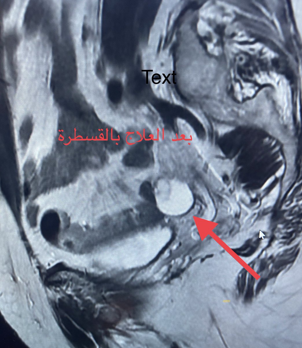 MadkhaliDr's tweet photo. الكيس البريتوني ينتج عن التصاقات من عمليات سابقة في الحوض او التهابات او بطانة مهاجرة او التهاب الزائدة المعقدة. يسبب ألم في الحوض او ضغط على المثانة او اعضاء الحوض .الأشعة لسيدة بعد استئصال الرحم الكيس تسبب في الم و زيادة التبول تم علاجها بفضل الله بالأشعة  التداخلية. https://t.co/s2YyazP2T2