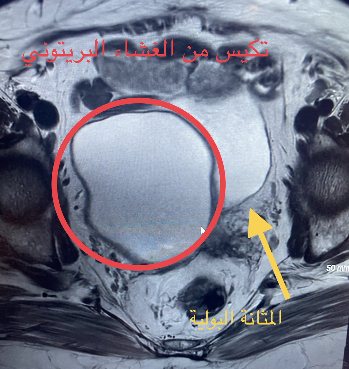 MadkhaliDr's tweet photo. الكيس البريتوني ينتج عن التصاقات من عمليات سابقة في الحوض او التهابات او بطانة مهاجرة او التهاب الزائدة المعقدة. يسبب ألم في الحوض او ضغط على المثانة او اعضاء الحوض .الأشعة لسيدة بعد استئصال الرحم الكيس تسبب في الم و زيادة التبول تم علاجها بفضل الله بالأشعة  التداخلية. https://t.co/s2YyazP2T2
