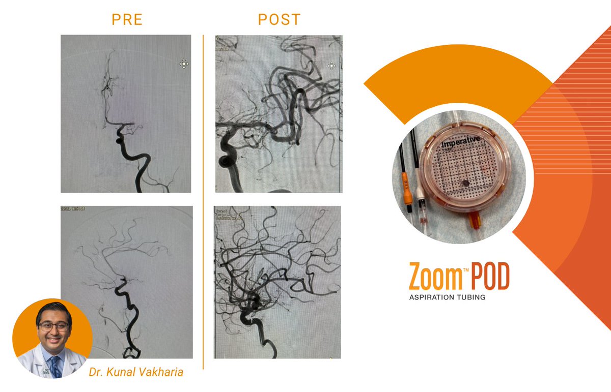 Imperative Care Stroke (@impcare_stroke) on Twitter photo Thanks for sharing this #ClotOfTheWeek, <a href="/KunalVakhariaMD/">Kunal Vakharia</a>. A full #ZoomStrokeSolution #stroke case using #TracStar. #Zoom71, #Zoom35 + #ZoomPOD.
Rx Only. ISI: bit.ly/3yWkfEJ Thanks for sharing this #ClotOfTheWeek, <a href="/KunalVakhariaMD/">Kunal Vakharia</a>. A full #ZoomStrokeSolution #stroke case using #TracStar. #Zoom71, #Zoom35 + #ZoomPOD.
Rx Only. ISI: bit.ly/3yWkfEJ