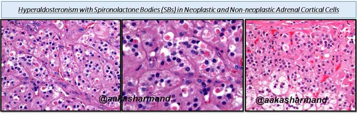 aakasharmand's tweet image. EndoPath fun @EndoPath @DrJuhlin @PennPathLabMed @itondiresta @MariaGoobs @CaDxPath @PathDocBoston @nicolecipriani @Sara_Jiang @ekhanafshar @pembeoltulu