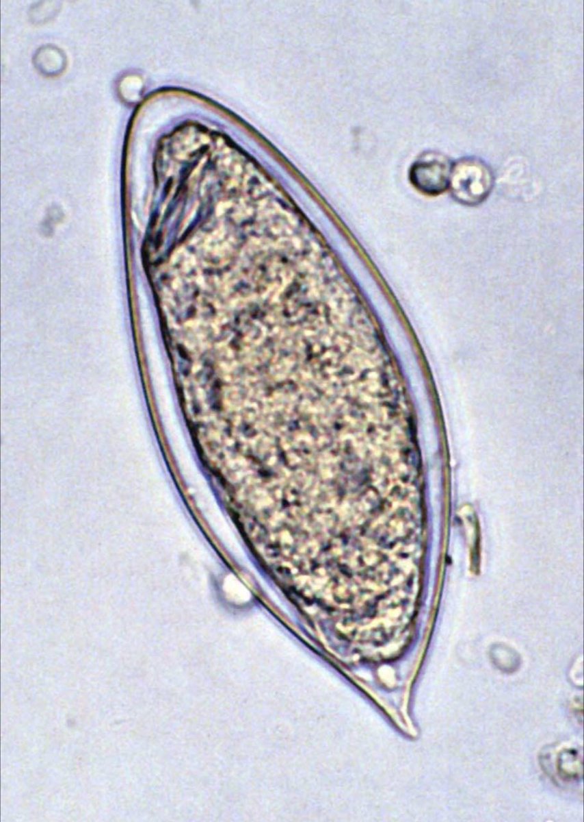 A young boy in Kenya p/w 2 weeks of fever &amp; abdominal pain. Exam is notable for hepatomegaly. He also has an urticarial rash in his left foot. Urine and stool microscopy are remarkable for these eggs &amp; a CBC demonstrated eosinophilia. What is the likely diagnosis? #MedEd