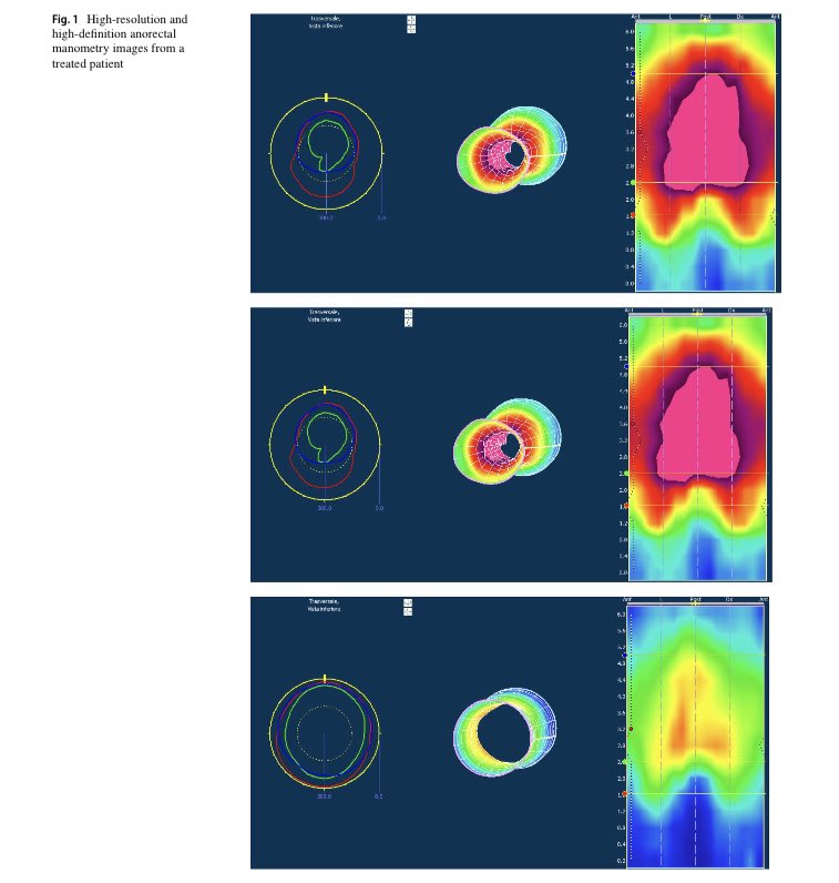 Autologous adipose-derived stromal vascular fraction and platelet concentrates for the treatment of complex perianal fistulas 

rdcu.be/c4umh

🆓 #OpenAccess <a href="/TechColoproctol/">Techniques in Coloproctology Journal</a> 
<a href="/YouSICCR/">Y-SICCR</a> <a href="/escp_tweets/">European Society of Coloproctology</a> <a href="/ECCongress/">European Colorectal Congress</a> #colorectalsurgery #SoMe4Surgery