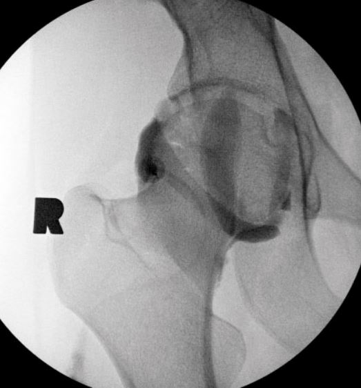 UW_MSKrad's tweet photo. #CaseOfTheWeek ‼️🎉‼️
☢️🩻☠️Case #5☠️🩻☢️
#CommonProcedure💉
🧐🔍Normal or pathologic?🔍🤔
#MSKRad #MSKIntervention #FOAMrad #radres #OrthoTwitter @UWRadRes https://t.co/pRYg4Uqis9