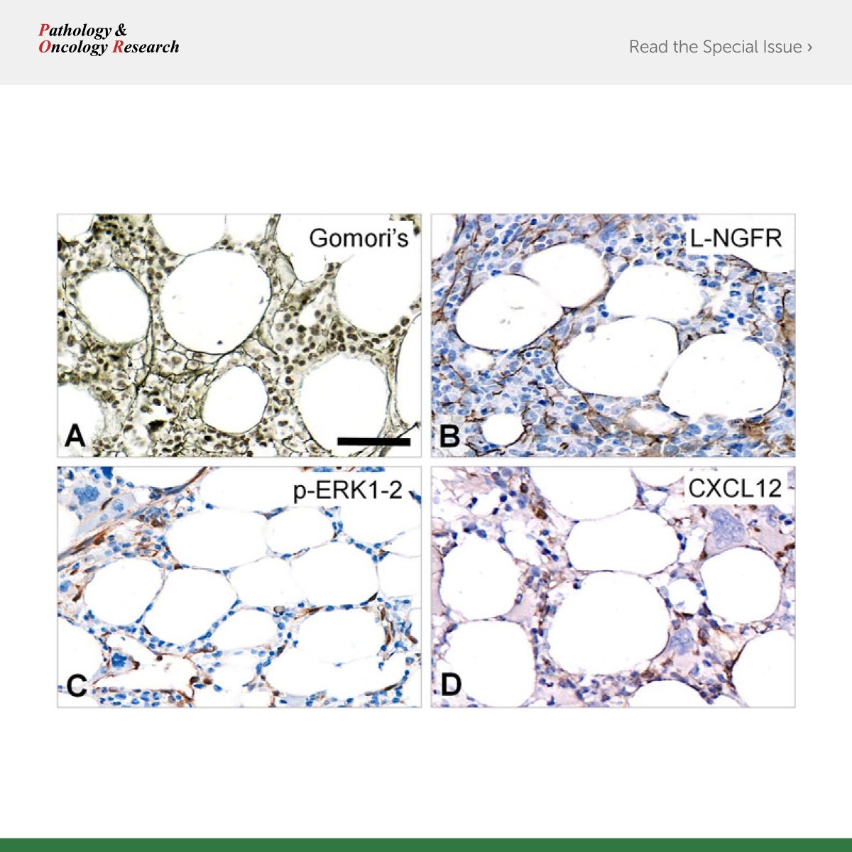 FrontPartners's tweet image. New in Pathology &amp;amp; #OncologyResearch! @semmelweishu researchers, including @BotondTimar, explore the correlation between growth-related biomarker expression in bone marrow stromal cells and #myelofibrosis.

👀Read the full text to see what they found. 

fro.ntiers.in/POR-1610217