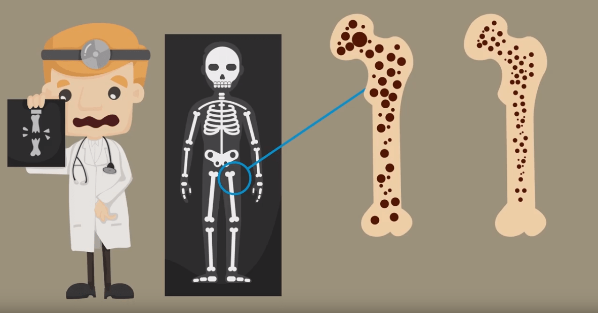 Dr_Maizo's tweet photo. ¿Sabías que la osteoporosis NO duele? La OMS la denomina una epidemia silenciosa porque no manifiesta síntomas hasta que la pérdida de hueso es tan importante como para que aparezcan fracturas. 

Así que si tienes dolor es muy seguro que sea otra la causa. Acude a tu médico 😊🩺 https://t.co/lzOXNPLWGM