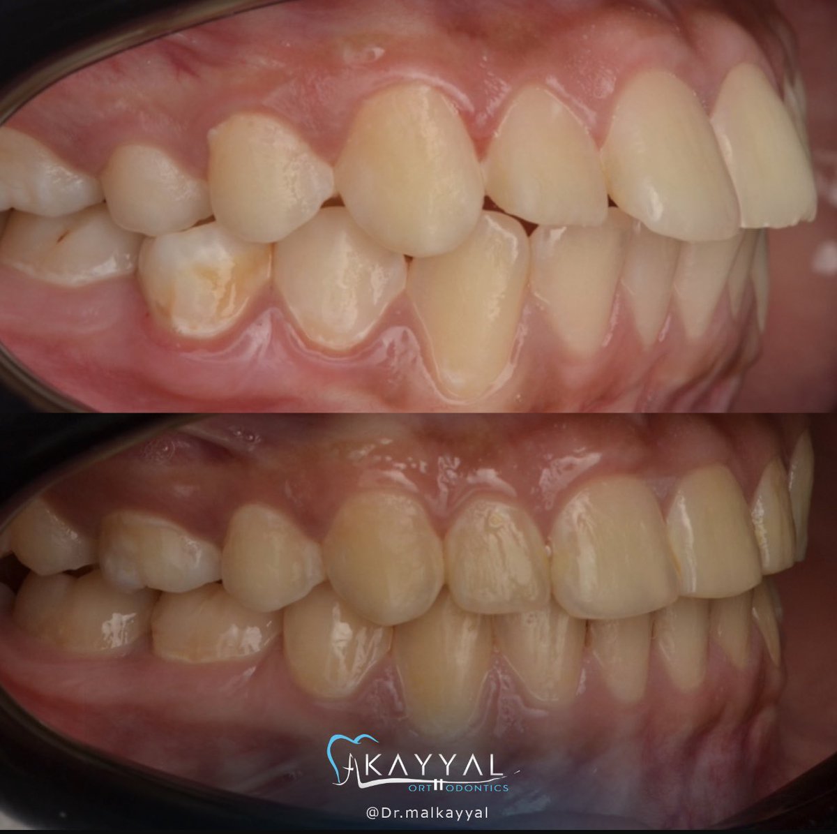 الصورة تتحدث 😍
.
#د_مؤيد_كيال #جدة #استشاري #تقويم_الأسنان  #صحة #ابتسامة_صحية #orthodontist #orthodontics #jeddah #ladenta #عيادات_لادنتا_الاستشارية_لطب_الأسنان