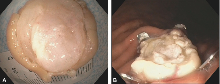 videogie's tweet photo. VideoGIE Editor's Choice: “Endoscopic resection of GI stromal tumor using full-thickness resection device: tips and tricks” by Ravi Jariwala et al. https://t.co/R9JqpzPDCx

@AbdulChafic https://t.co/T2dMDTp8vz