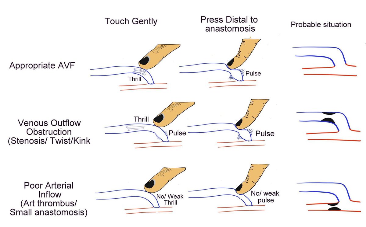 Dr Himanshu Verma (@varenyamvasc) on Twitter photo One of the simple ways to evaluate your anastomoses for AVF once its complete - <a href="/FutureVascSurgn/">FutureVascSurgeons</a> <a href="/VascularForum/">Fórum Vascular</a> <a href="/EJVES_ESVS/">EJVES</a> <a href="/VascularSVS/">Vascular SVS</a> One of the simple ways to evaluate your anastomoses for AVF once its complete - <a href="/FutureVascSurgn/">FutureVascSurgeons</a> <a href="/VascularForum/">Fórum Vascular</a> <a href="/EJVES_ESVS/">EJVES</a> <a href="/VascularSVS/">Vascular SVS</a>