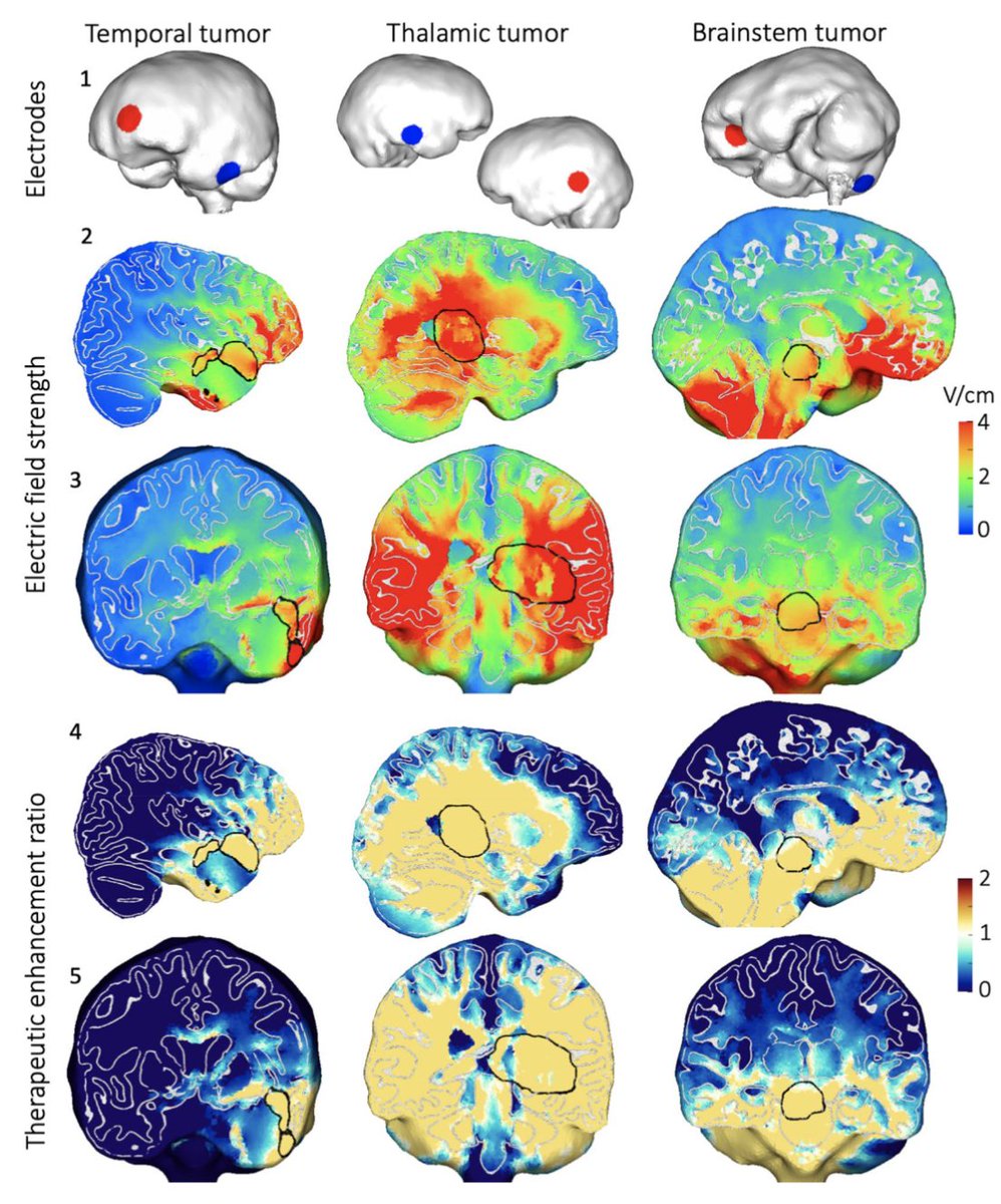 David Segar (@davesegar) on Twitter photo Could tumor treating fields be more effective if implanted intracranially?
Check out our in silico results in <a href="/SciReports/">Scientific Reports</a>, where we explore the potential advantages of bypassing the skull for the treatment of high grade glioma.
rdcu.be/c4rFt Could tumor treating fields be more effective if implanted intracranially?
Check out our in silico results in <a href="/SciReports/">Scientific Reports</a>, where we explore the potential advantages of bypassing the skull for the treatment of high grade glioma.
rdcu.be/c4rFt