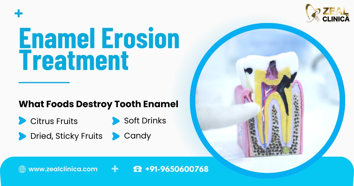 A dental expert 👨‍⚕️ can provide the right dental 😬 enamel erosion treatment if you have suffered severe #EnamelErosion. Tooth crowns and tooth 🦷 bonding are two major dental procedures that a dentist uses for treating enamel erosion.

#dentalenamel #oralcare #oralhealth #dentist