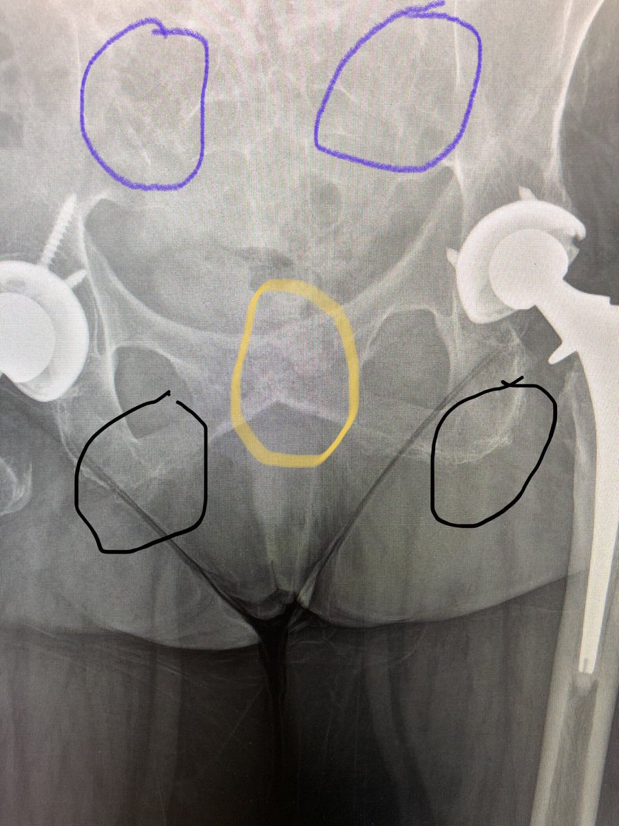 #ClinicalPearl A woman with severe #ankylosing spondylitis. Fused SI jts (ghost joints). Fused pubic symphysis. X-ray changes at tendon insertions ex bilateral pubic rami #MedicalTwitter