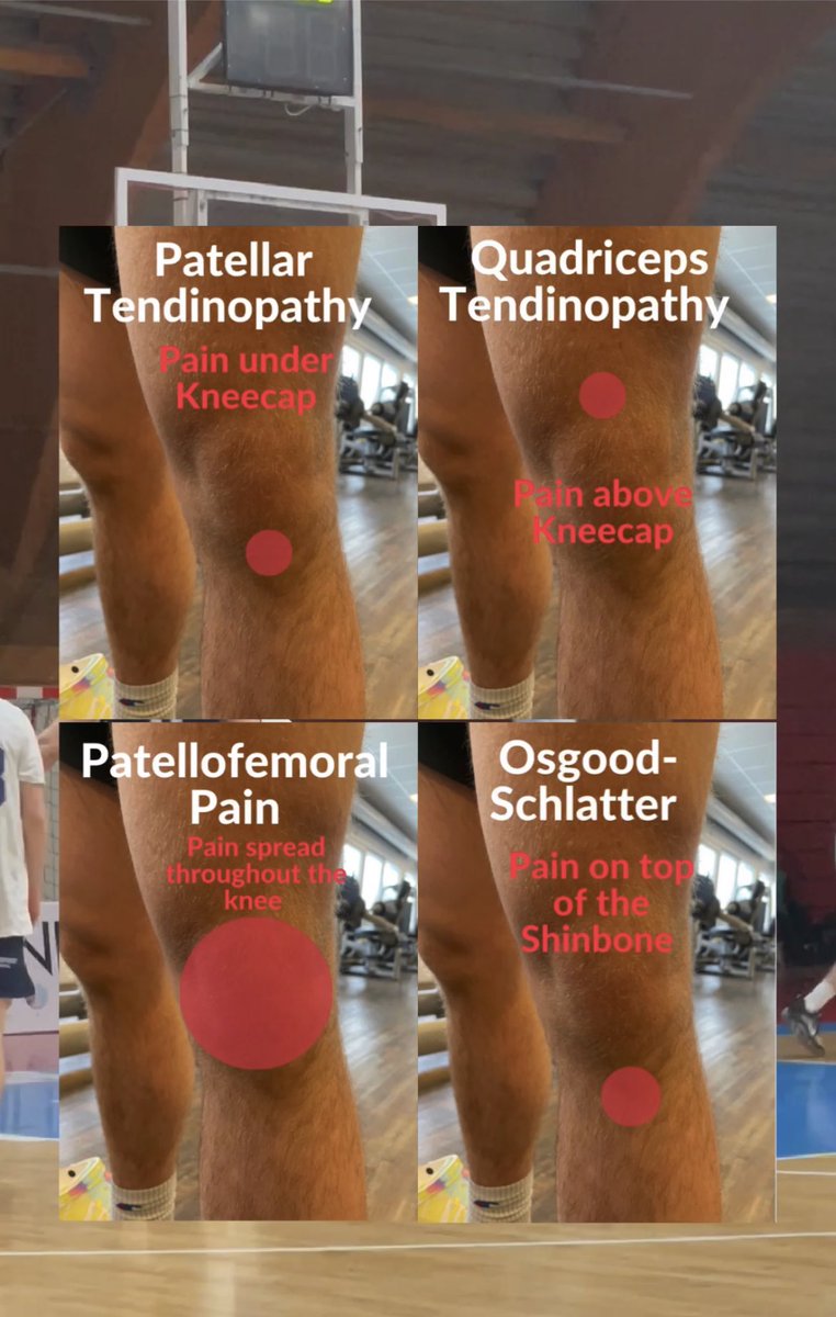 KNOW YOUR KNEE PAIN❌🦵

#tendon #tendinopathy #tendonitis #patellartendonitis #patellartendon #jumpersknee #kneepain #kneerehab #physicaltherapy
#strengthandconditioning #athleticperformance #bodybuilding #powerlifting #training #lifting #fitness