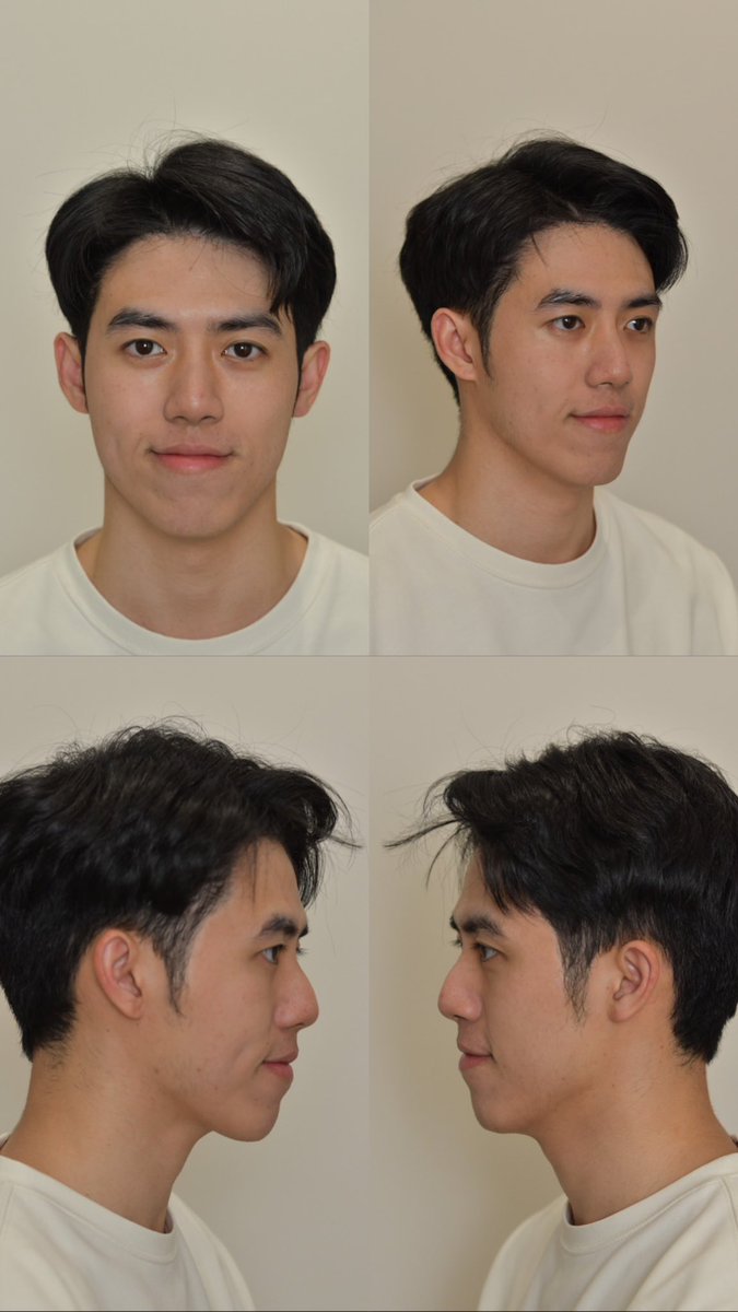 pleumnkhn's tweet photo. Pico laser ครั้งที่1 ✅ ความเจ็บ แค่6/10 แต่ผิวหน้าหลังทำ รู้สึกดีขึ้นจริง https://t.co/E5RAsTdg0h