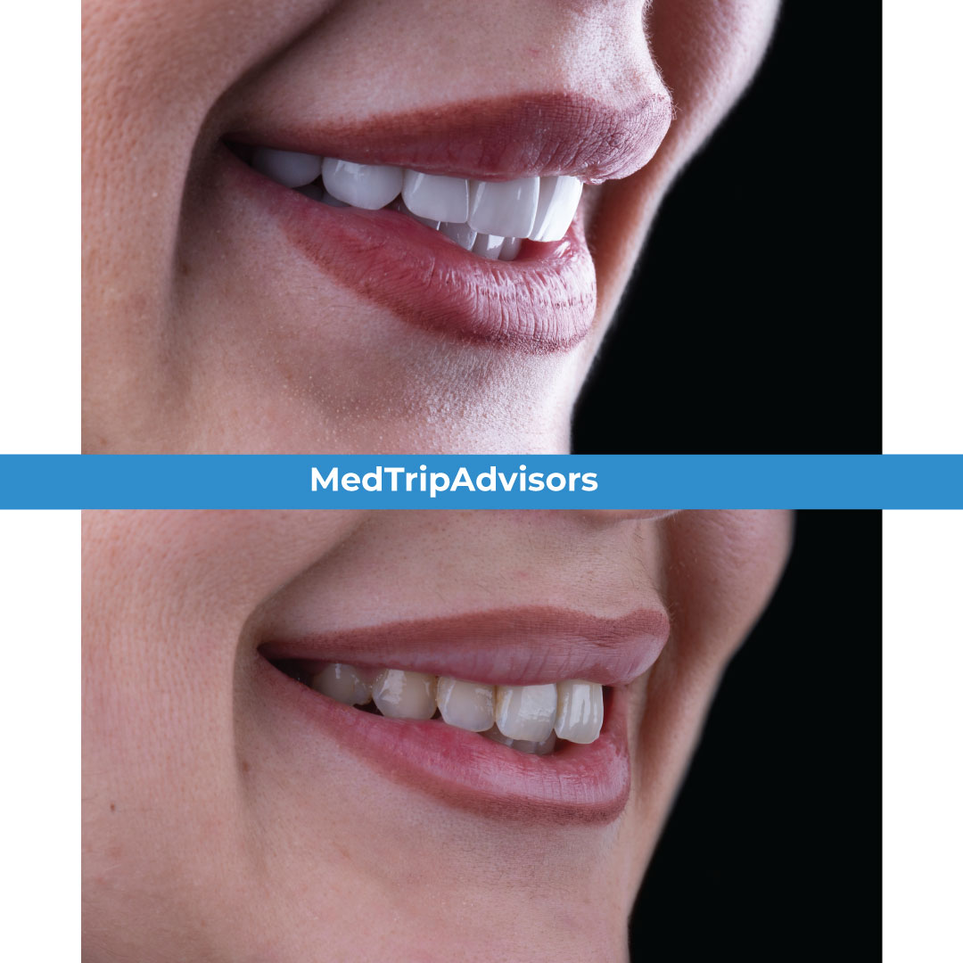 Transform your smile into a red carpet-worthy look.

#beforeandafter #success #confidenceboost #newbeginnings  #healthcare #healthtrip #medicaltourism #medicaltrip #healininTurkey #wellness #healthcare #healthtrip #hollywoodsmile #teeth