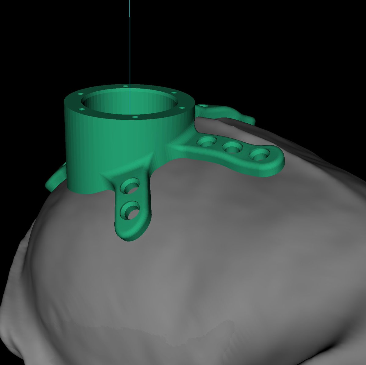 cortexplore's tweet image. We are now offering titanium implants that match the skull like 🤟. Place the implant at your preferred position and we do the rest for you. Of course, you can directly navigate the parts with CORTEXPLORER SCI.