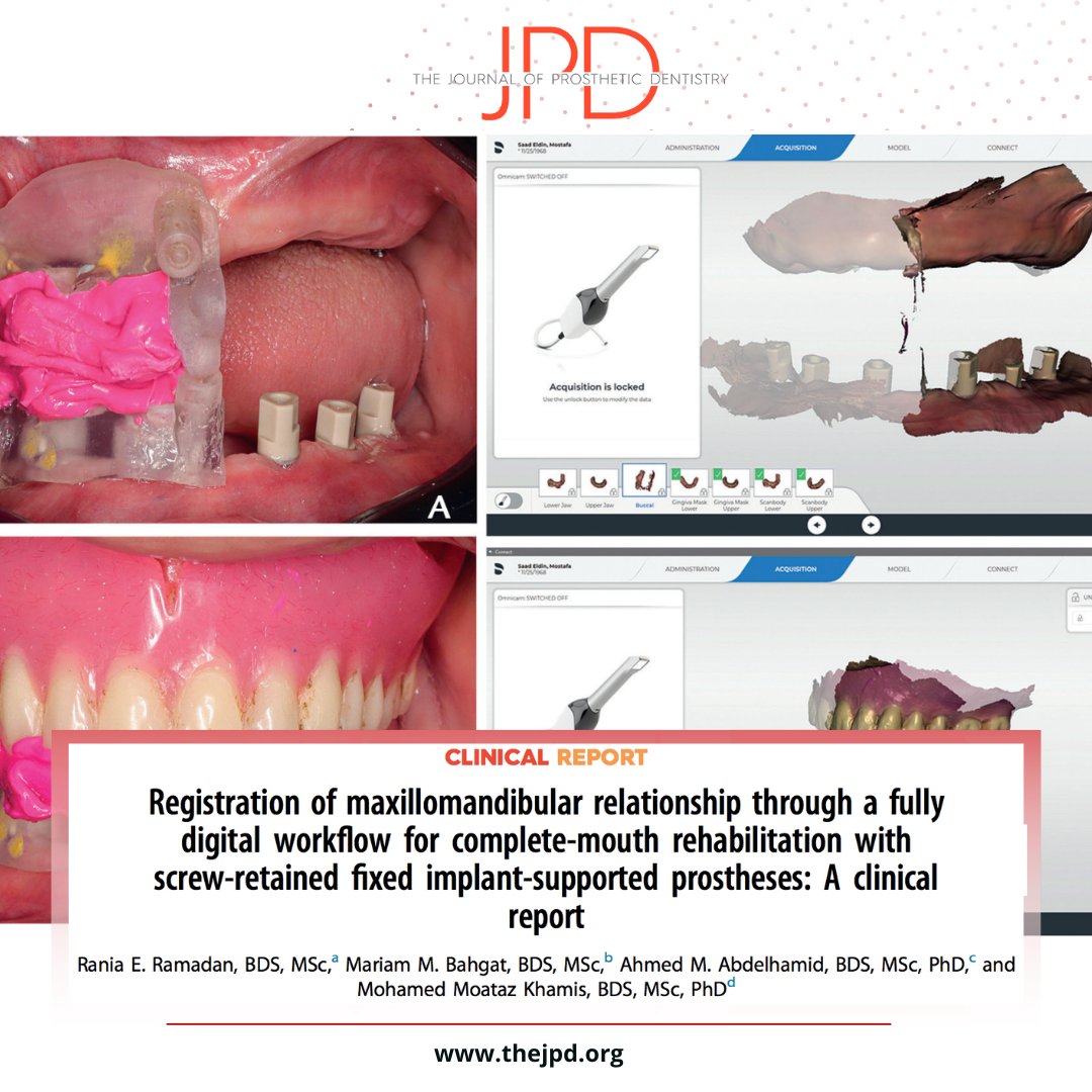 JPDentistry's tweet photo. An #implant #surgicalguide and #dentures that can occlude against one another is the foundation of an efficient workflow that allows #dentalimplant #intraoralscanning within the prosthetically appropriate #occlusalverticaldimension position: https://t.co/CEKNm0wopF https://t.co/fytGu3YpDr