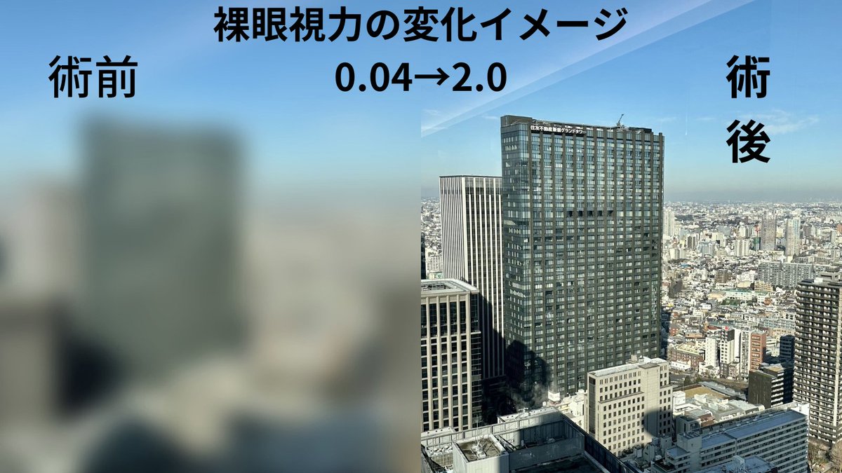ICL_surgery's tweet photo. ・これから受けようと検討している方
・すでに受けた方

の声も集めています。
経験や悩みを共有して、皆さんが後悔の無いICL手術を受けられるようにしたいです😊

ICLを受けられた方にアンケートをお願いしています。
https://t.co/rUPBg7JA2U https://t.co/Ifun3yXYFO