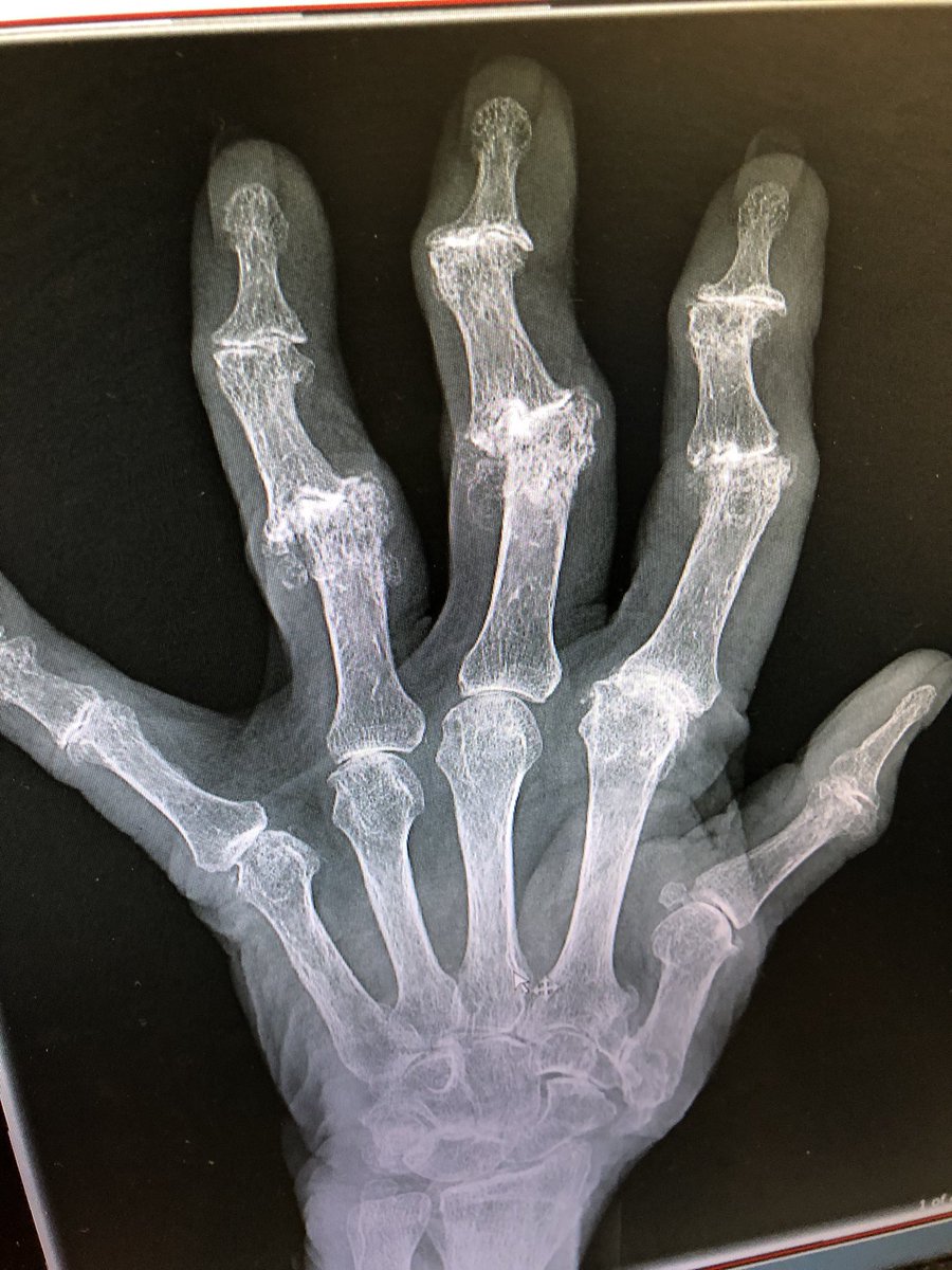 Janetbirdope's tweet photo. #Rashweek #ClinicalPearl #MedEd #MedTwitter Elderly woman with hand pain. No previous #diagnosis. What is on differential dx? Hint look at 2nd MCP. Bonus - what about bone quality. https://t.co/q2VW5NhgKF