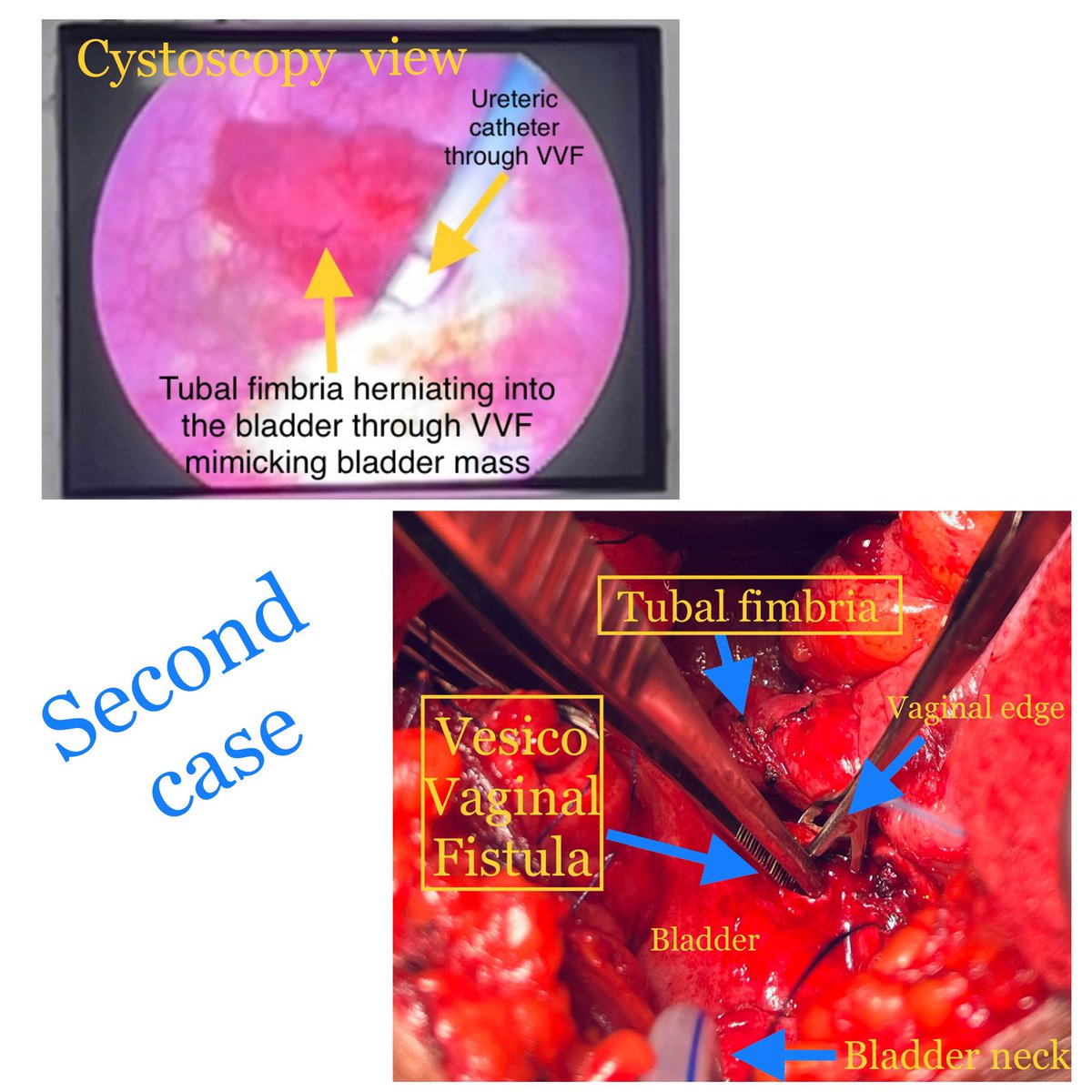 My second case of tubal fimbria herniating into the bladder through Vesico vaginal fistula mimicking bladder tumour (post Hysterectomy). Trans abdominal modified O’Connor repair done.

#urineleakage #vesicovaginalfistula
#incontinence #VVF #urology #urogynaecology 
#Womenhealth