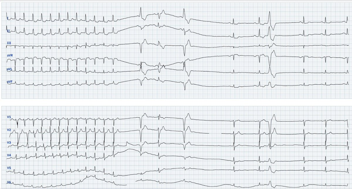 LopezLizarraga_'s tweet image. Otro tipo de respuesta, quizá la mas buscada.
Terminación de la taquicardia en un paciente con taquicardia por reentrada intranodal típica.
La adenosina bloquea la conducción a nivel del NAV y aborta el mecanismo de reentrada. #ecgfirst #pmcardio @JL_MoralesArt @Yldifonso777