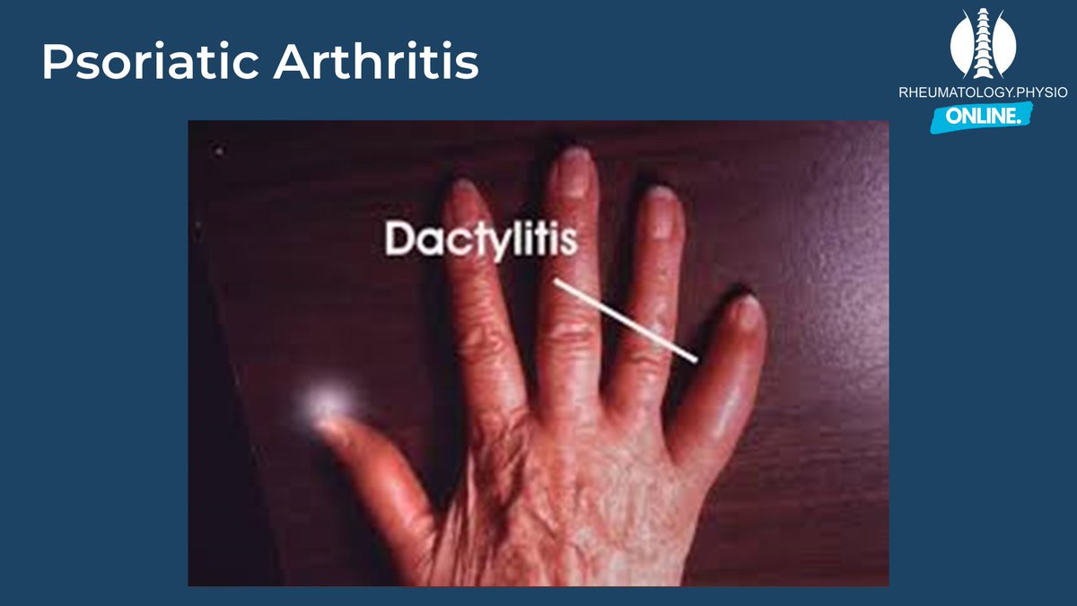 The Rheumatology Physio on Twitter "Sausage digit? That is a thing