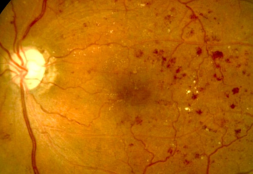 Hallmark of the diabetic Retinopathy is...............?
For answer see the description.
#ophthotwitter #MedTwitter
@mazhry @eyeacuity 
#Retina #DiabeticRetinopathy #AntiVEGF
#V_ophthalmology   #VOPHA #Ophthalmology  #AAO #Optometry  #eyehealth #eyeacuity