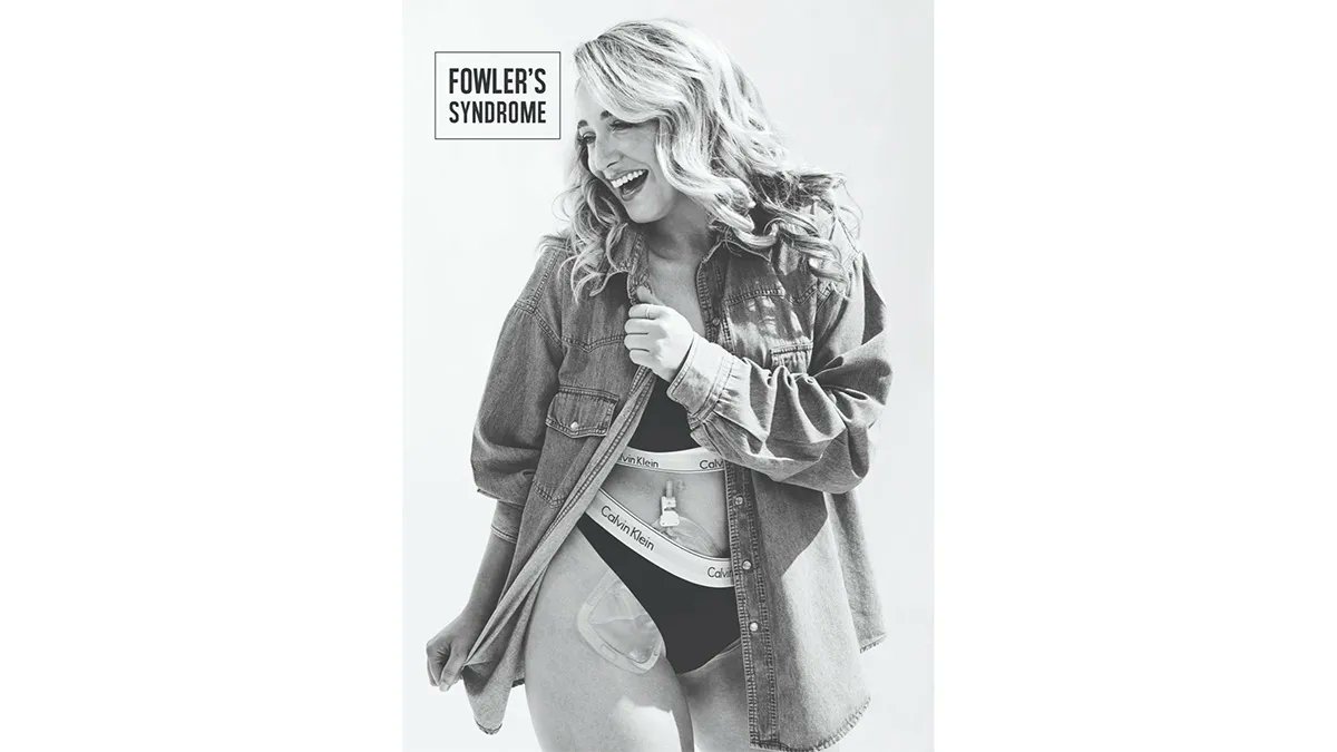 NightingaleHDS's tweet image. Last year we spoke to Aoife from @bisforbladder about living with Fowler's Syndrome and a Suprapubic Catheter. As it is #FowlersFebruary, now seems like a good time to share her story again buff.ly/3DbYHYv