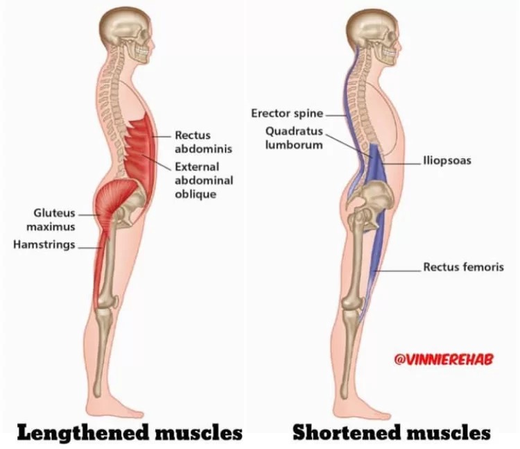 مقال مهم جداا عن علاقة عضلات الفخذ الأمامية والخلفية  بثبات الحوض (pelvic)  
لقراءة المقال 👇👇 physiolair.com/muscle-imbalan…