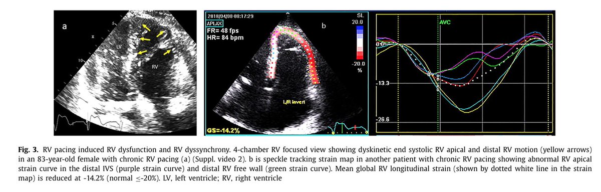 Ed_Alania's tweet photo. 🟣Adverse effects of RV pacing on cardiac function: prevalence, prevention &amp; treatment with physiologic pacing #CardioEd #Epeeps #Cardiology #echofirst https://t.co/szPQAgK8Nb