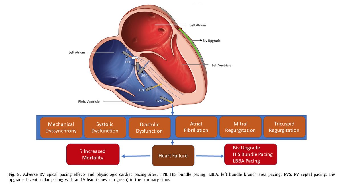 Ed_Alania's tweet photo. 🟣Adverse effects of RV pacing on cardiac function: prevalence, prevention &amp; treatment with physiologic pacing #CardioEd #Epeeps #Cardiology #echofirst https://t.co/szPQAgK8Nb