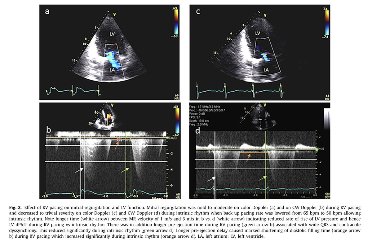 Ed_Alania's tweet photo. 🟣Adverse effects of RV pacing on cardiac function: prevalence, prevention &amp; treatment with physiologic pacing #CardioEd #Epeeps #Cardiology #echofirst https://t.co/szPQAgK8Nb