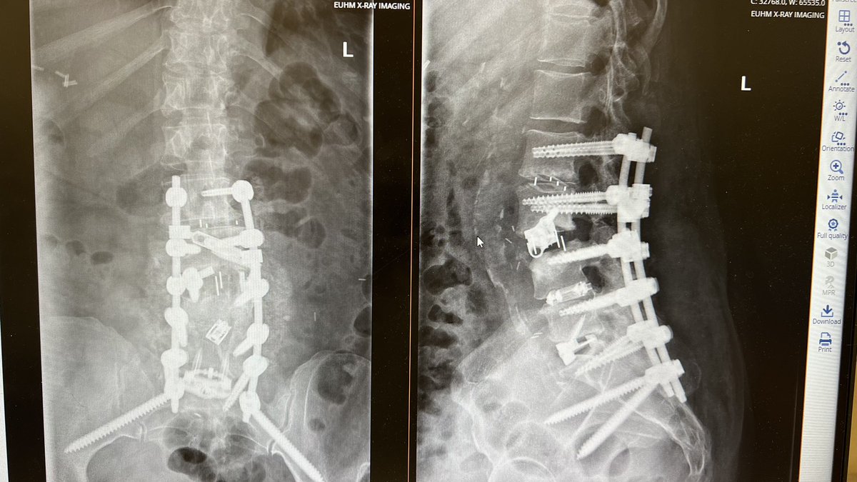 Given her severe positive SVA surgical plan was a L5/S1 ALIF, L2-4 OLIF, and posterior L2-Pelvis instrumented fusion. The olif was challenging given the grade 3 spondy but an expandable trial helped with the reduction. @CNS_Update @spinesection