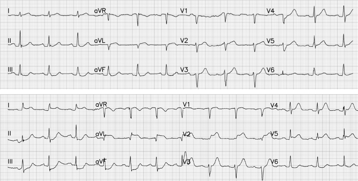 Two 70 year olds with chest pain, and 3 pitfalls of the STEMI paradigm  <a href="/ECGcases/">Jesse McLaren</a> 

hqmeded-ecg.blogspot.com/2023/02/two-70…