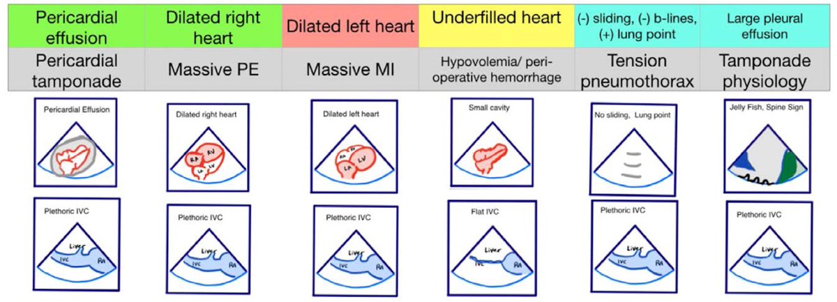 drshahrul80's tweet photo. “#POCUS Spotlight: Point-of-Care Ultrasound in Cardiopulmonary Resuscitation.”  @ASRA_Society #FOAMcc #FOAMus #EMCCM #echofirst #CPR #EASy_ALS_protocol #CriticalCareUltrasound #MedEd #MedTwitter #FOAMsim 🔗 https://t.co/eoEepLRP5u https://t.co/GlJGxcKVUY