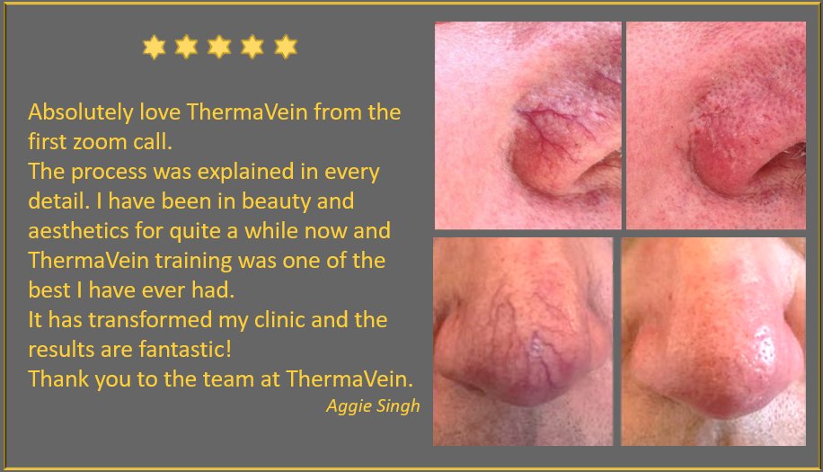 thermavein's tweet photo. Safe, instant treatment for thread veins/spider veins using ThermaVein's unique technology.
Get in touch for more information or if you would like to see a demo of the equipment.
Email: info@thermavein.com
#thermavein #threadveins #redveins #spiderveins #beauty #aesthetics https://t.co/A26uwMBMJC