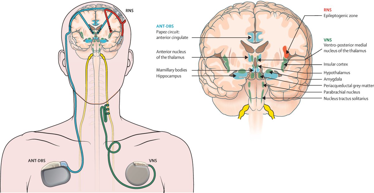 Neuromodulation is an alternative therapy to antiseizure drugs and surgery for people with drug-resistant epilepsy. This Review in @TheLancetNeuro discusses three approved approaches: hubs.li/Q01C2W2Y0 #EpilepsyDay