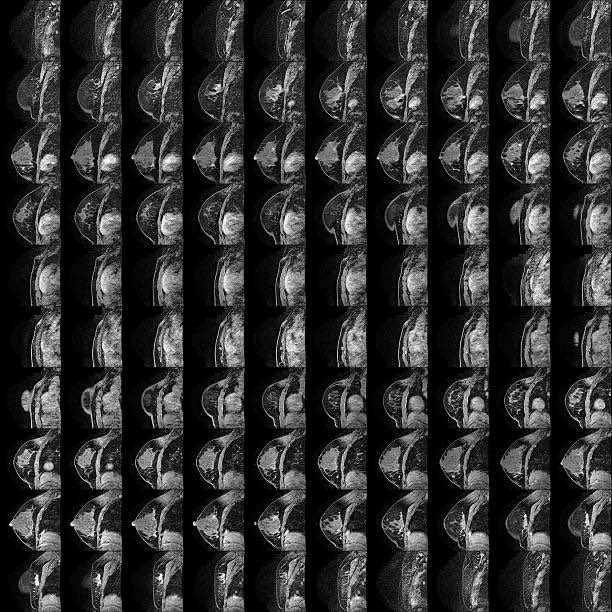 Breast MRI assists in decision-making for surgical excision of atypical ductal hyperplasia

surgjournal.com/article/S0039-…

<a href="/WinbladOnalisa/">Onalisa Winblad</a> <a href="/KU_Surgery/">KU Dept. of Surgery</a> <a href="/KURadiology/">KU Radiology</a> <a href="/KUcancercenter/">KU Cancer Center</a> 
<a href="/amandaaminmd/">Amanda L. Amin, MD MS</a> <a href="/UHhospitals/">University Hospitals</a> <a href="/UHSurgOncology/">UH Surgical Oncology</a>

<a href="/SWexner/">Steven D Wexner MD, PhD</a> <a href="/juliomayol/">Julio Mayol</a> <a href="/SusanPoriesMD/">Susan Pories</a>

#SoMe4Surgery