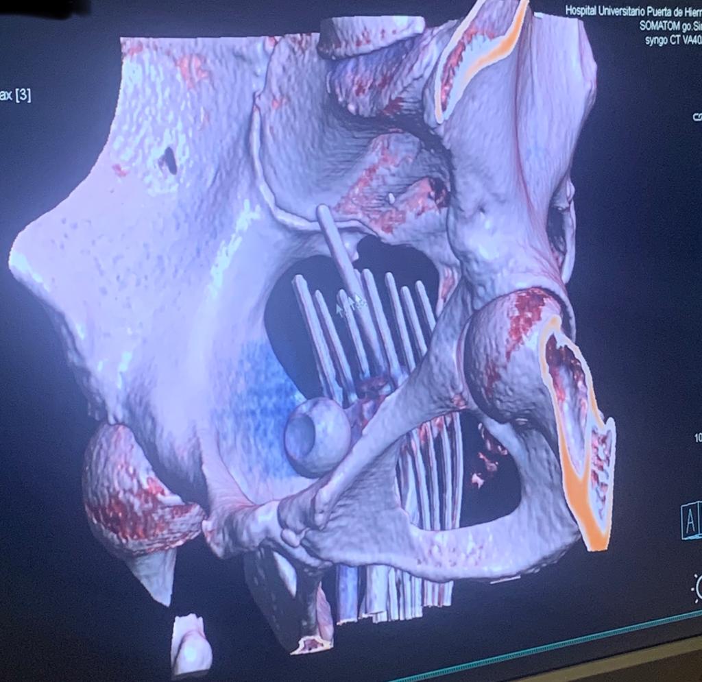 3D reconstruction of an intersticial braquitherapy cervical cancer implant