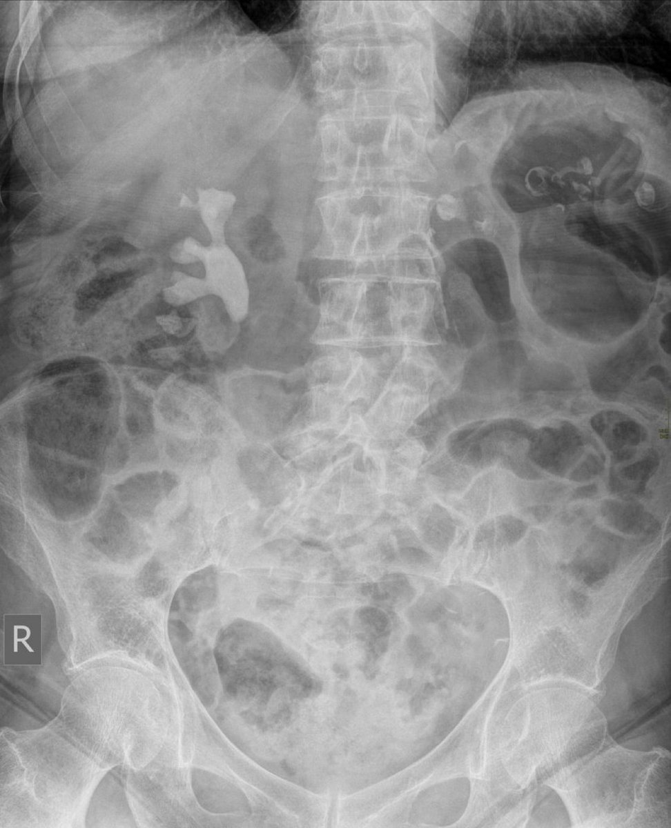 BrownJHM's tweet photo. A 90 year old woman presented with recurrent UTI’s. What is the likely diagnosis? (Image @Radiopaedia, case by Ian Bickle) #MedTwitter https://t.co/IXq8vMcnTQ