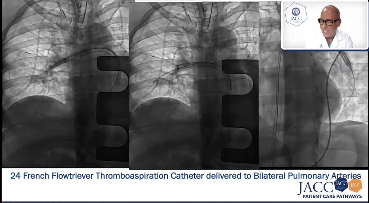 shonmd's tweet photo. 🚨🚨🚨 Acute PE intervention🫁 with @InariMedical  FlowTriever highlighted in @JACCJournals Interventions Patient Care Pathways this week.  Screen shot here from a great discussion with Dr. Fuster, Dr. Lookstein, and others.  Highly recommend!

https://t.co/zZlKAwO5ON https://t.co/e8qExaTQFs