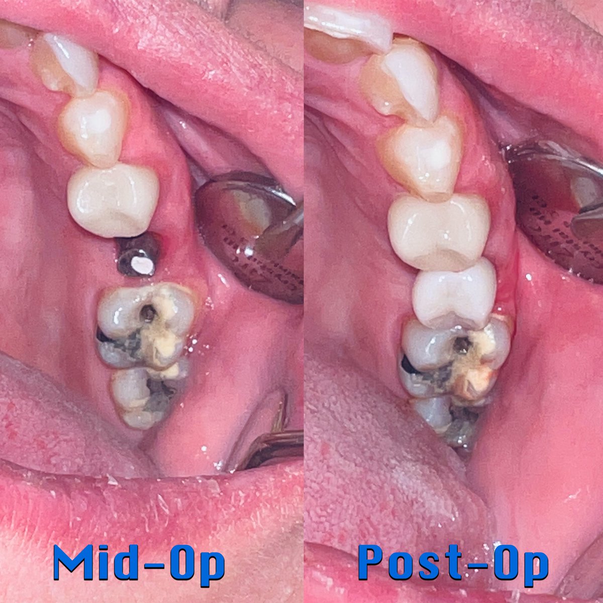 cdic_dmd's tweet photo. Fransina came to our office with a missing #13 and she wanted an implant retained restoration. It took us a total of three months to complete the case. Look at the results! Patient is super happy. 
#dentistry #charlotte_dentist #RameshSunar #DrRush #cosmeticdentist https://t.co/OOgu6c8Aat