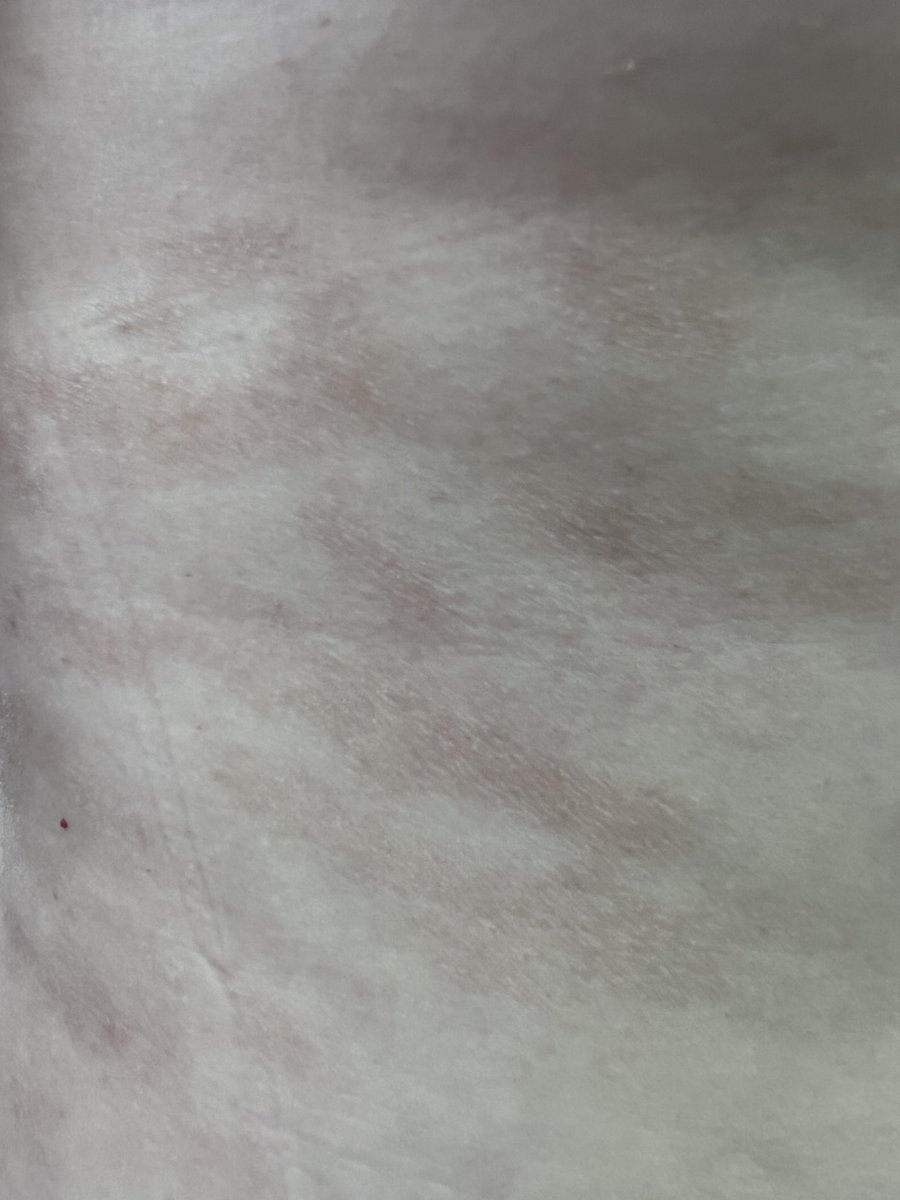 derm_bossy's tweet photo. T-cell lymphoma (mycosis fungoides) https://t.co/7fNqkmF5OE