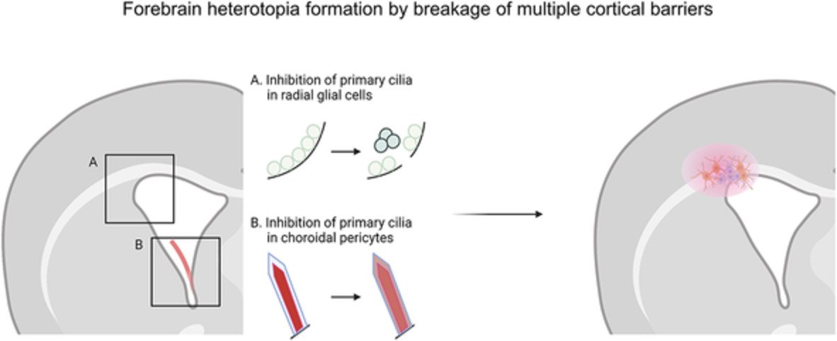 brainpathol's tweet image. Brain #heterotopia formation by ciliopathic breakdown of neuroepithelial and blood-cerebrospinal fluid barriers
#KBRI
onlinelibrary.wiley.com/doi/10.1111/bp…