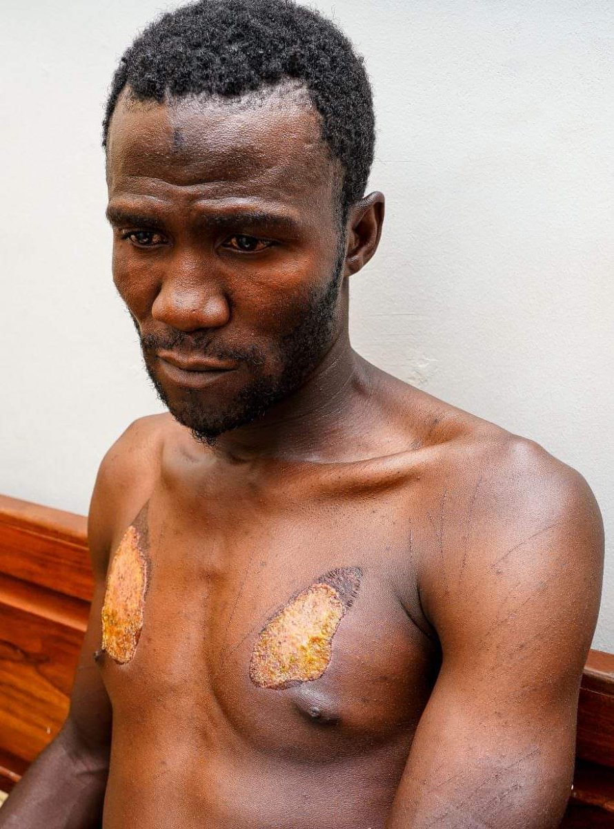 This is Eric Mwesigwa,he was abducted&amp;tortured,burning him with hot metalic objects. The Chairperson of Uganda Human Rights Commission,Mariam Wangadya is going to come out&amp;say something like, "This man was not tortured,he just fell down while being arrested&amp; got these injuries"!!