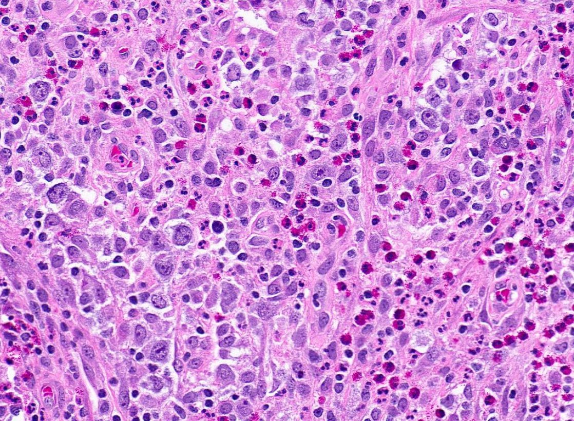 SibaElHussein's tweet photo. Mediastinal grey zone lymphoma, classic Hodgkin lymphoma-like:
🩸Confluent pleomorphic cells admixed with eosinophils &amp; dense fibrotic stroma 
🩸Uniform strong expression of CD20, PAX5 &amp; at least one additional B marker (CD19, CD79a, BOB1, OCT2)  
🩸CD30+

#hemepath #lymsm https://t.co/7yngjLUESw