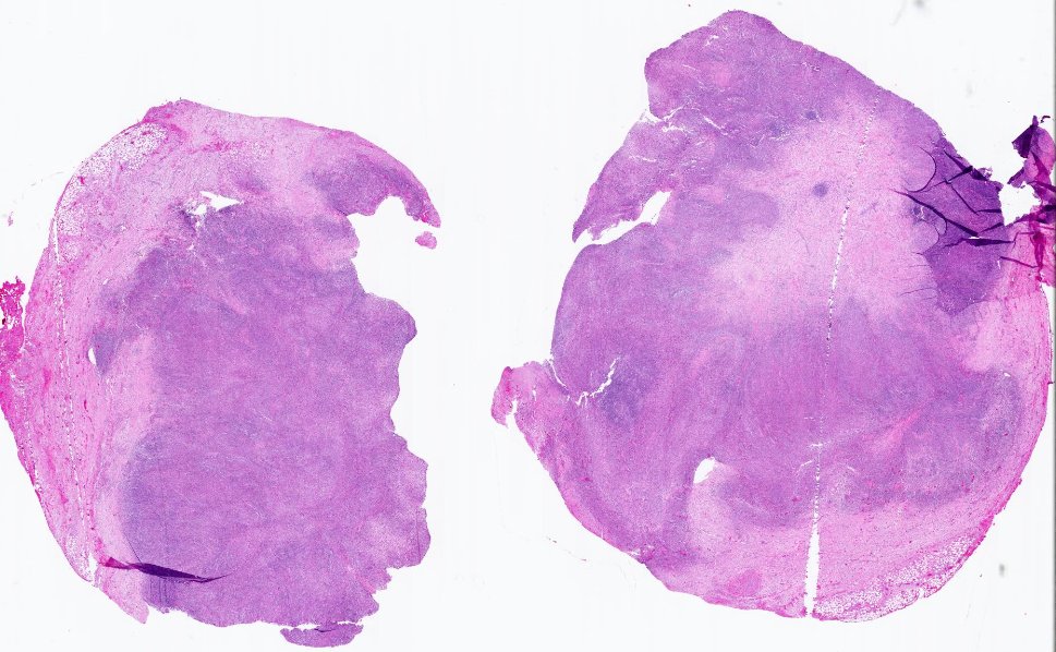 SibaElHussein's tweet photo. Mediastinal grey zone lymphoma, classic Hodgkin lymphoma-like:
🩸Confluent pleomorphic cells admixed with eosinophils &amp; dense fibrotic stroma 
🩸Uniform strong expression of CD20, PAX5 &amp; at least one additional B marker (CD19, CD79a, BOB1, OCT2)  
🩸CD30+

#hemepath #lymsm https://t.co/7yngjLUESw